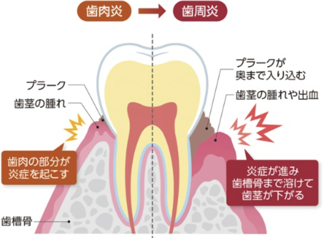 歯周病とは