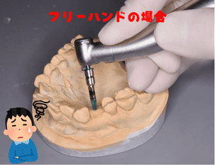インプラントを正確に埋入するためのシミュレーション画像