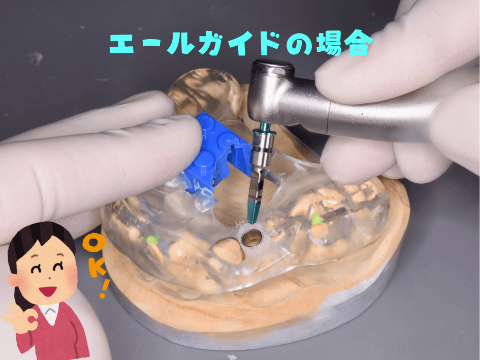 サージカルガイド（エールガイド）を使用したインプラント埋入計画